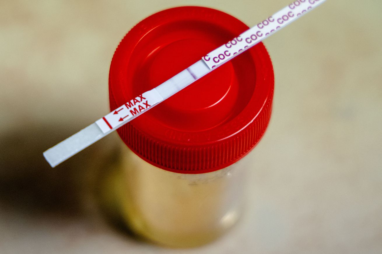 A photo of a urine sample to be tested by a laboratory.